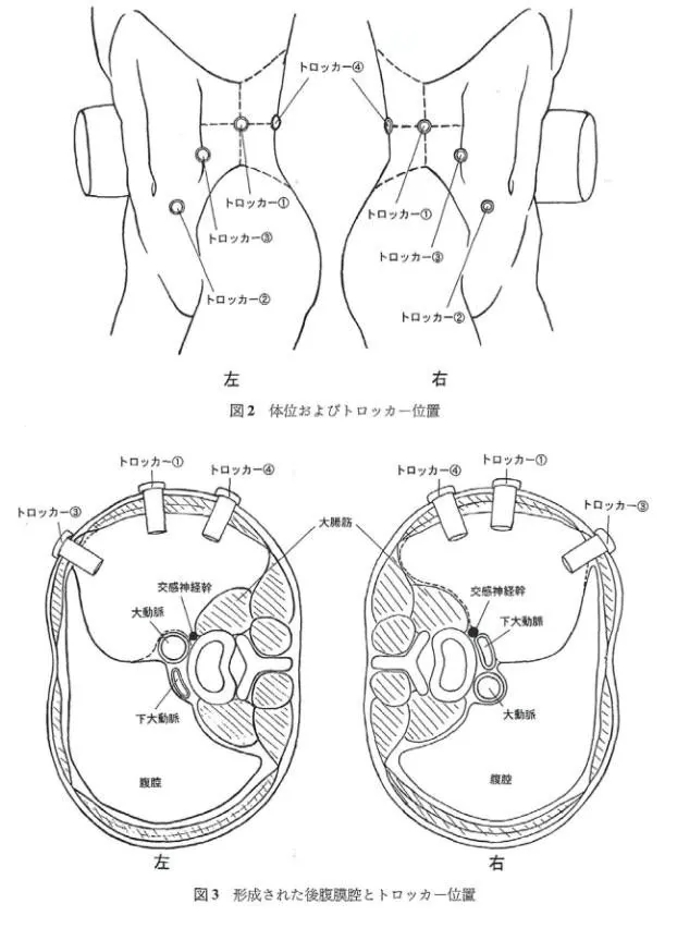 トロッカーの位置　図